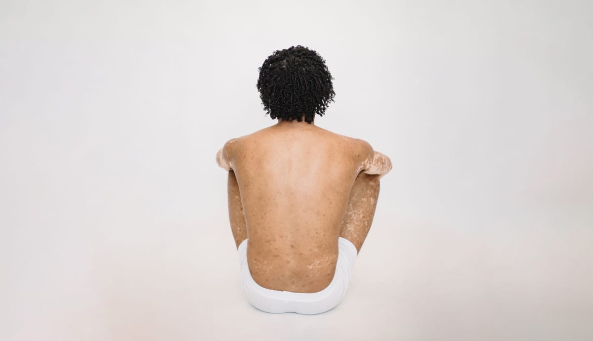 Pickel am Po – Ursachen und 9 effektive Tipps zur Behandlung