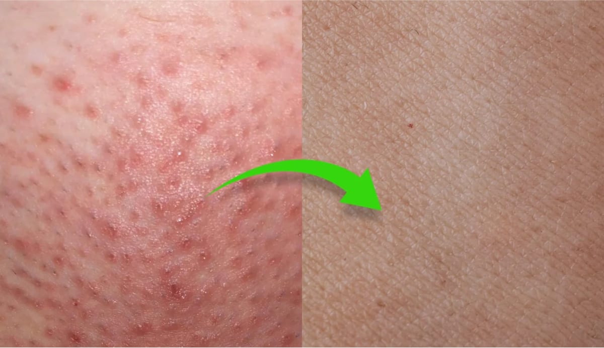 Rasurbrand vermeiden: Tipps für die Verwendung eines Elektrorasierers